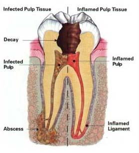 pulpitislabel